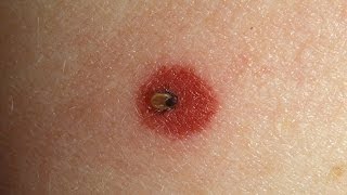 How to Spot Lyme Disease  WebMD [upl. by Onateag190]