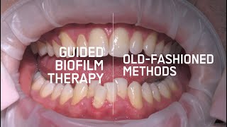 Guided Biofilm Therapy VS Old Hygiene Treatment [upl. by Abrahan]