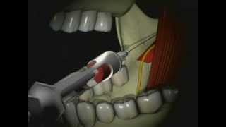 Mandibular Anesthesia  Inferior Alveolar Nerve Block [upl. by Aderf]