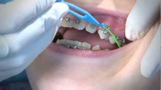 How to Wear Orthodontic Elastic Bands [upl. by Youlton]