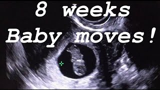 8 weeks ultrasound Baby moves [upl. by Abbott]