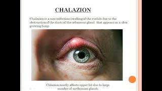 Diseases of Eyelid 1 Chalazion ophthalmology by JD [upl. by Noiek]