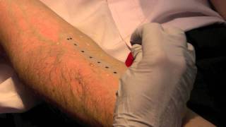 Skin Prick Allergy Test [upl. by Eerrehc336]