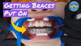 Process of Getting Braces [upl. by Duarte]