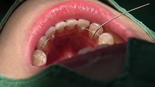 Bonded lingual fixed retainer in 10 min [upl. by Christyna]