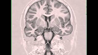 Mesial Temporal Sclerosis Right [upl. by Milly]