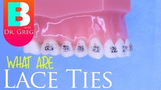 Lace Ties for Braces [upl. by Aneehsar206]