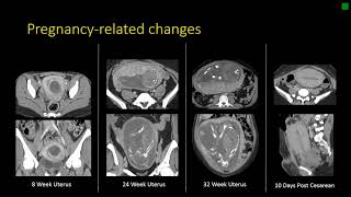 Gynecologic Radiology Anatomy [upl. by Assirahs989]