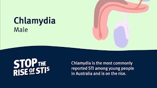 Chlamydia Know the Facts [upl. by Ellimahs]