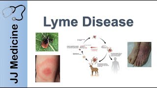 Lyme Disease  Pathophysiology Signs and Treatment [upl. by Venetis]