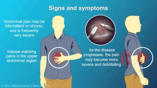 Chronic Pancreatitis [upl. by Khalsa]