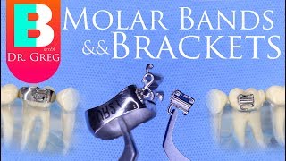 Braces Bands vs Brackets for Molars in Orthodontics [upl. by Tombaugh]