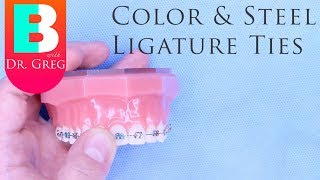 BRACES EXPLAINED Color and Steel Ligature Ties [upl. by Ahsenre]