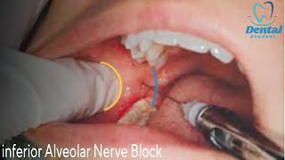 Inferior alveolar nerve block amp Live demo بشرح مفصل [upl. by Anidualc]