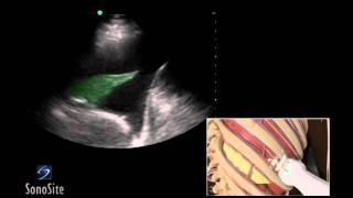 How To Ultrasound Guided Thoracentesis Exam 3D Video [upl. by Redwine814]