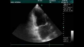 Apical hypokinesis echocardiography doppler ultrasound [upl. by Sussman]