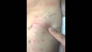 What is allergy testing [upl. by Forest945]